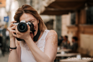 5 vragen over vitiligo - Sunday Brush