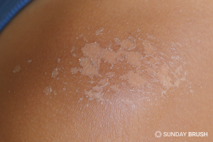 5 waardevolle tips tegen zonverbranding - Sunday Brush