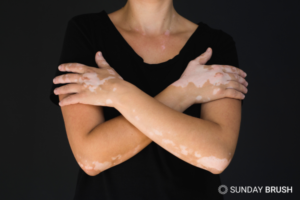 Zonbescherming en Vitiligo - Sunday Brush